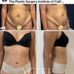 Advanced Surgical Institute - Tummy Tuck