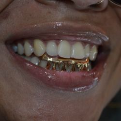 Baltimore Gold Fronts - Customer.