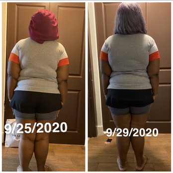 Jardin Bleu Spa - This is after 4 visiting dieting and exercising I also drink lost of water 100oz a day - Medical Spas Near Me - Deerfield Beach, Florida