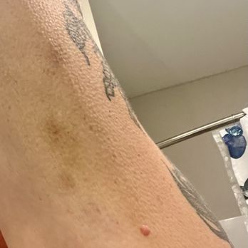Capri Ristorante - Bruises from bouncers hands - Italian Near Me - Burr Ridge, Illinois