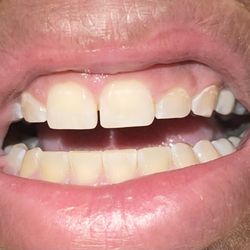 ProSmiles Dental - After they worked on my teeth