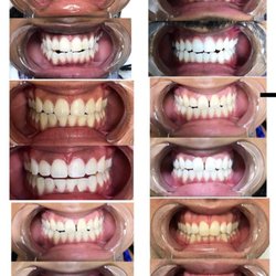 Minte Teeth Whitening