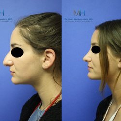 Matt Hershcovitch, MD - Rhinoplasty Before and After