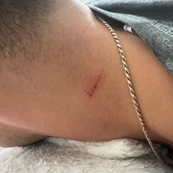 Elite Barbers - Deep razor cut right on my neck because he was so careless! - Barbers Near Me - New York, New York Elite Barbers - Deep razor cut right on my neck because he was so careless! - Barbers Near Me - New York, New York