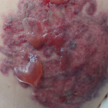 Removery Tattoo Removal & Fading - This wouldn't post with my review, but here's what removery did to me. - Tattoo Removal Near Me - Austin, Texas Removery Tattoo Removal & Fading - This wouldn't post with my review, but here's what removery did to me. - Tattoo Removal Near Me - Austin, Texas