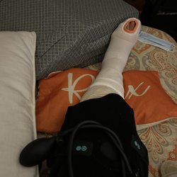 Chicago Center For Sports Medicine and Orthopedic Surgery - Day of surgery following Doctor's orders. Ice packed wrapped and elevated.
