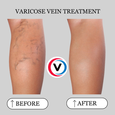 Varicose Vein - Using ultrasound-guided radiofrequency ablation (RFA), we close off diseased veins with minimal discomfort. The procedure is performed entirely in-office, takes about an hour, and patients walk out the same day. No general anesthesia, no hospital stay, no lengthy recovery. Varicose Vein - Using ultrasound-guided radiofrequency ablation (RFA), we close off diseased veins with minimal discomfort. The procedure is performed entirely in-office, takes about an hour, and patients walk out the same day. No general anesthesia, no hospital stay, no lengthy recovery.