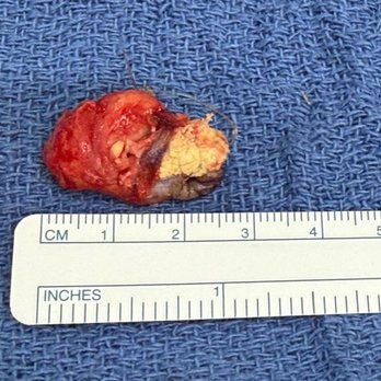Valero Surgery - Solid inch long - Cosmetic Surgeons Near Me - Tijuana, BCN