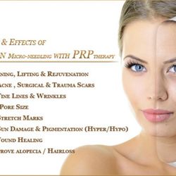 Radiant Divine Medical Spa - PRP offered at Anew Medspa Brecksville!