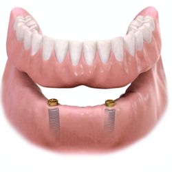 Premier Dental Center - Lockhart - Overdentures are replacement teeth retained by dental implants. The improved stability allows you to chew food more thoroughly no adhesives.