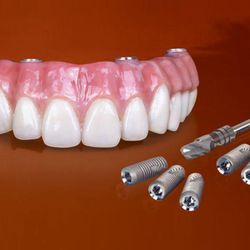 Ohana Dental Implant Centers - Grand Junction