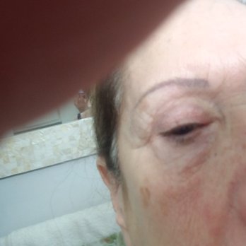 Del Mar Plastic Surgery - Eyelid lift. Can see scars after 2 yrs. - Plastic Surgeons Near Me - San Diego, California Del Mar Plastic Surgery - Eyelid lift. Can see scars after 2 yrs. - Plastic Surgeons Near Me - San Diego, California