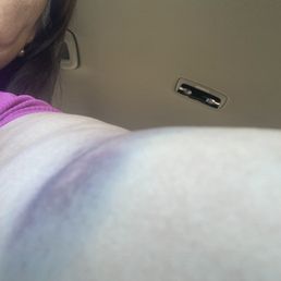 See the bruises from the guy grabbing and pulling my purse and arm See the bruises from the guy grabbing and pulling my purse and arm