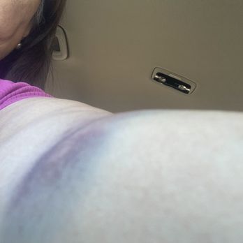 Sieu Thi Thuan Phat - See the bruises from the guy grabbing and pulling my purse and arm - International Grocery Near Me - Garden Grove, California Sieu Thi Thuan Phat - See the bruises from the guy grabbing and pulling my purse and arm - International Grocery Near Me - Garden Grove, California