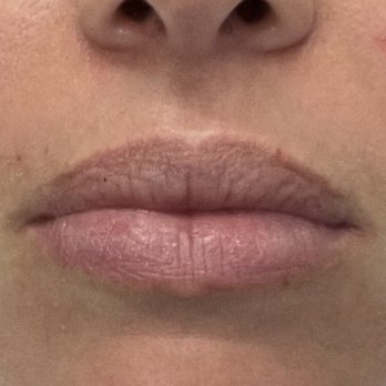 Plump Cosmetics & Injectables - Before - Dermatologists Near Me - New York, New York