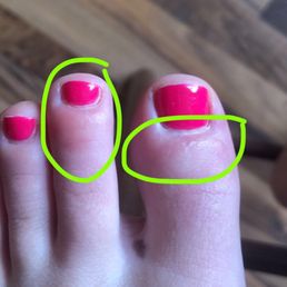 My toes were swollen and had little tiny blisters. Very sore and sensitive. My toes were swollen and had little tiny blisters. Very sore and sensitive.