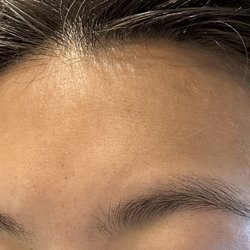 Acne Institute - No whiteheads at all, smooth thanks to Hannah