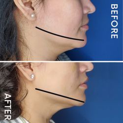 Atma Health - With PDO threads, we were able to lift sagging skin, jowls, and contour the face by inducing the healing response to create fresh collagen.