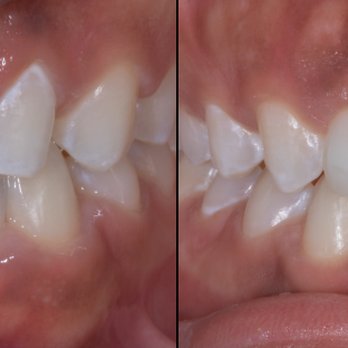 The Dental Equation - Porcelain Veneers
Bondings
Resins
Smile Design
No Prep Veneers - General Dentistry Near Me - Mamaroneck, New York The Dental Equation - Porcelain Veneers
Bondings
Resins
Smile Design
No Prep Veneers - General Dentistry Near Me - Mamaroneck, New York