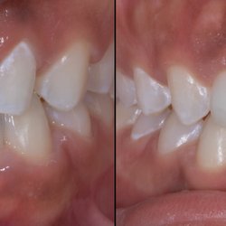 The Dental Equation - Porcelain Veneers
Bondings
Resins
Smile Design
No Prep Veneers
