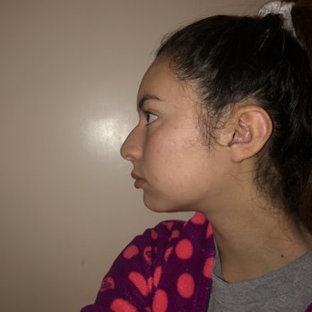 Changes Plastic Surgery & Spa - (before) left profile - Cosmetic Surgeons Near Me - San Diego, California