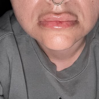 NakedMD - Day 3 post Versa filler (the top left lip with the 2 bruises that doesn't look as full as the right side) - Medical Spas Near Me - Downey, California NakedMD - Day 3 post Versa filler (the top left lip with the 2 bruises that doesn't look as full as the right side) - Medical Spas Near Me - Downey, California