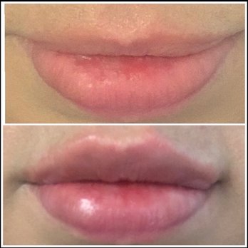 Total Health & Wellness - Before and after lip filler - Medical Spas Near Me - Temecula, California Total Health & Wellness - Before and after lip filler - Medical Spas Near Me - Temecula, California