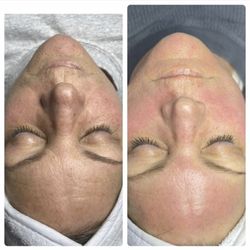 After Glow Esthetics - Before & after 2 procell microchanneling treatments. 2 months apart
