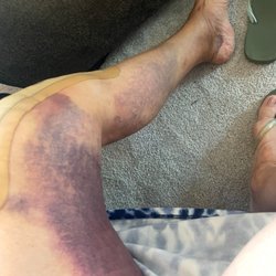 Precision Orthopedics & Sports Medicine - All of the bruising is as a result of the use of a tourniquet