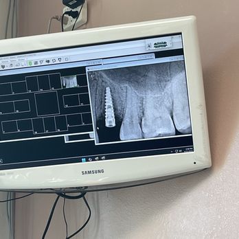 Smiles Northridge - Look how nicely positioned that implant looks in the front! - General Dentistry Near Me - Northridge, California Smiles Northridge - Look how nicely positioned that implant looks in the front! - General Dentistry Near Me - Northridge, California