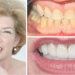 AnaBella Family and Cosmetic Dentistry - Before and After of our bruxism patient. Full mouth reconstruction