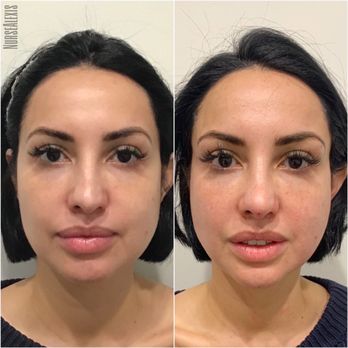 Spa De La Peau - Before and after day of. - Medical Spas Near Me - Los Angeles, California Spa De La Peau - Before and after day of. - Medical Spas Near Me - Los Angeles, California