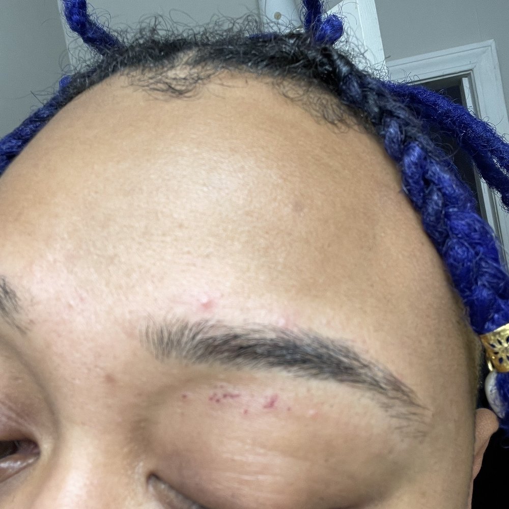 I Too - Day 2 of eye lid scarring - Eyelash Service Near Me - Atlanta, Georgia