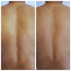 Aura Skin & Laser - Before (Left) and After 3 Weeks (Right)
