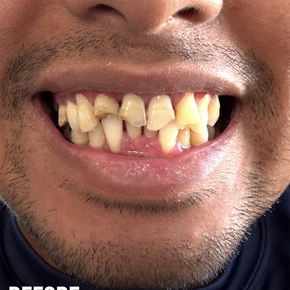 Watts Dental - This was me before I went to watts dental. - General Dentistry Near Me - Apollo Beach, Florida Watts Dental - This was me before I went to watts dental. - General Dentistry Near Me - Apollo Beach, Florida