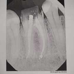 Western Dental & Orthodontics - Xray of completed root canal molar. Dr. Martin