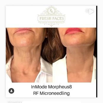 Fresh Faces Rx - Morpheus8 - Medical Spas Near Me - Portland, Oregon Fresh Faces Rx - Morpheus8 - Medical Spas Near Me - Portland, Oregon
