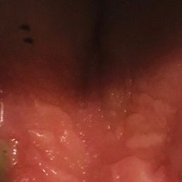 Blisters and two red lines are where took cut roof of mouth. Blisters and two red lines are where took cut roof of mouth.