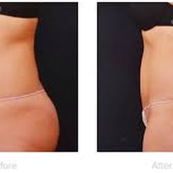 V Medical Spa - Come in to see our all new Vanquish! Heat away fat cells in as little as 4 weeks. Call now for free Consultation! (559)739-1042.