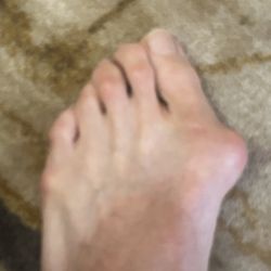 Bob Baravarian, DPM - This the before picture my old foot out with the old in with the new