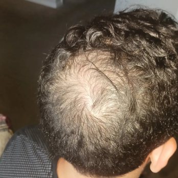 Micro Scalpp - Hair Loss Centers Near Me Micro Scalpp - Hair Loss Centers Near Me
