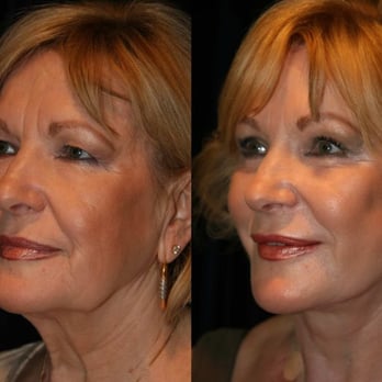 Christopher Verbin, MD - Dr. Verbin performed a facelift on this lovely woman. - Cosmetic Surgeons Near Me - Torrance, California Christopher Verbin, MD - Dr. Verbin performed a facelift on this lovely woman. - Cosmetic Surgeons Near Me - Torrance, California