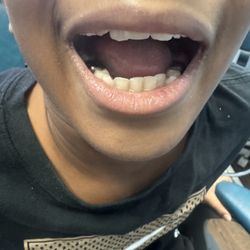 Kids Dental - They did a thorough cleaning the a week & half before. They placed silver Capps to protect his teeth today! Love them!