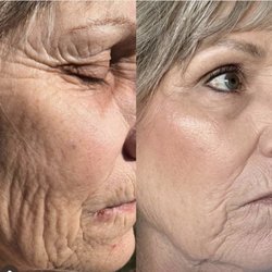 Rejuvenecimiento facial con plasma rico en plaquetas precio $350 por dos sessiones facial profundo incluido