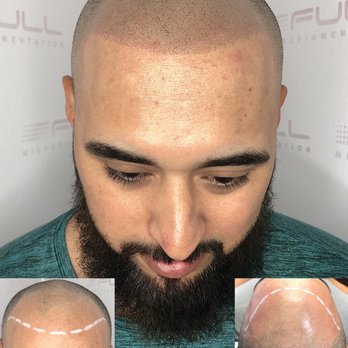 Full Micropigmentation - Smp - Hair Loss Centers Near Me - Las Vegas, Nevada Full Micropigmentation - Smp - Hair Loss Centers Near Me - Las Vegas, Nevada