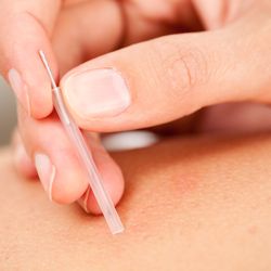 Berube Physical Therapy - Kalispell - Dry Needling