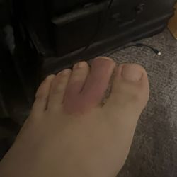 Bruening Foot & Ankle: Jeffrey J. Bruening, DPM - Redness spreading to two toes