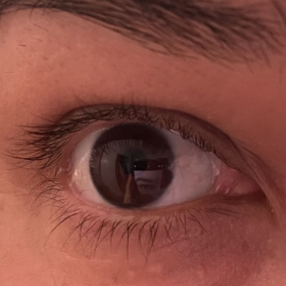 Laser Eye Center - Encino - Después de la cirugía. Se ve el injerto dentro del iris, el injerto no debe notarse. - Laser Eye Surgery/Lasik Near Me - Encino, California Laser Eye Center - Encino - Después de la cirugía. Se ve el injerto dentro del iris, el injerto no debe notarse. - Laser Eye Surgery/Lasik Near Me - Encino, California