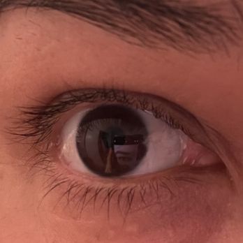 Laser Eye Center - Después de la cirugía. Se ve el injerto dentro del iris, el injerto no debe notarse. - Laser Eye Surgery/Lasik Near Me - Encino, California