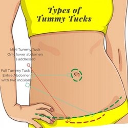 Andover Plastic Surgery: George P. Chatson, MD - Types of Tummy Tucks for Boston Area Patients